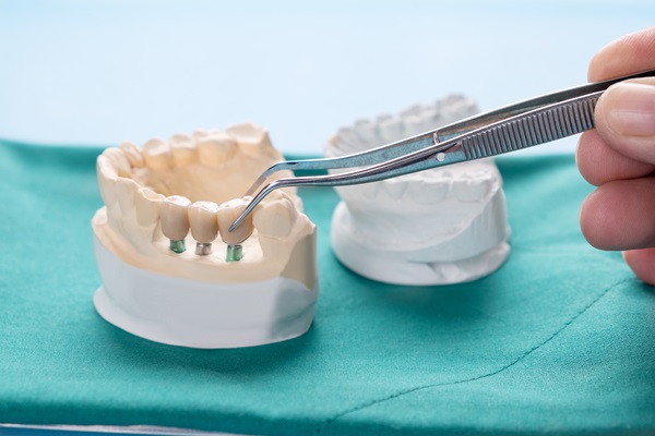 Recovery Tips After An Implant Supported Dentures Procedure